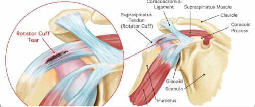 2025肩袖损伤重磅指南出炉!手术VS保守,AAOS给出逐条答案
