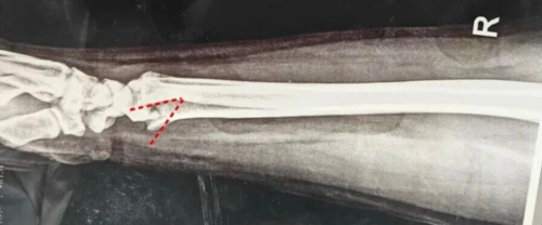 基层必备手法:桡骨远端骨折手法复位时如何避免掌侧遗留嵌插角度?