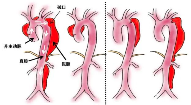 为什么有主动脉夹层分型,有哪几种分型,这篇给你讲明白了!