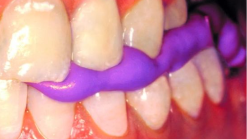 咬合记录硅橡胶和蜡片的区别