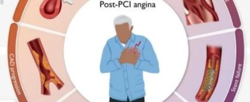 半数 PCI 患者术后仍有心绞痛,病因多样,欧洲心脏杂志文章