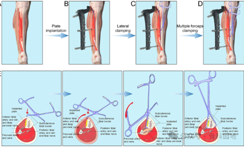 经皮钳形复位,微创钢板内固定治疗胫骨干骨折手术技术