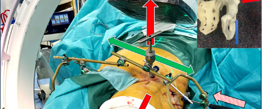 巧用外固定器：骨盆骨折经皮复位新方法