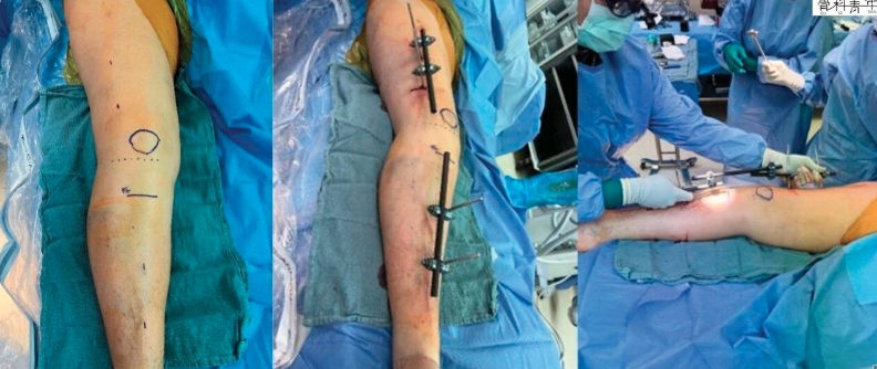 “无透视”的下肢外固定架技术：极端条件下的操作方法