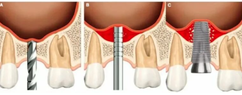 上颌窦底提升专家共识