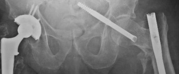  “任性的螺钉”：头髓拉力螺钉盆腔内移位的罕见病例报道