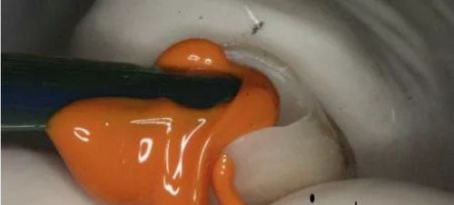 如何采用硅橡胶快速去除戴牙支点