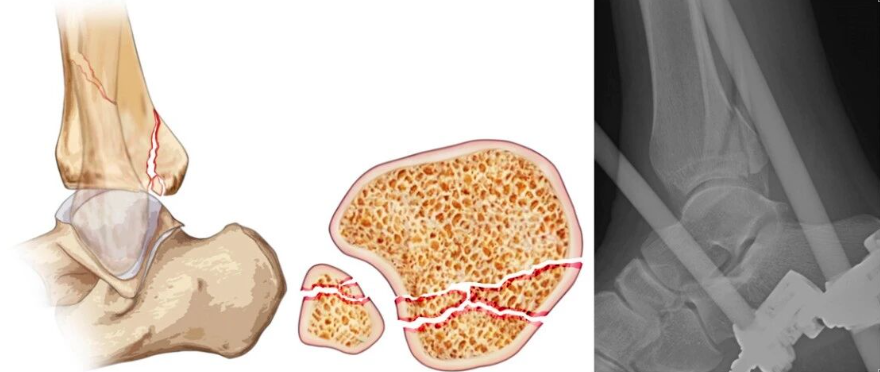 JBJS：后踝骨折、后Pilon骨折及后Pilon变异型骨折的定义与治疗