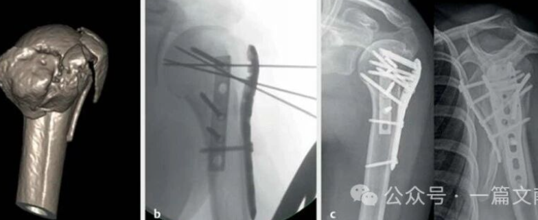 上肢骨折的双钢板固定技术