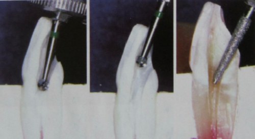 开髓必须掌握的八个要点