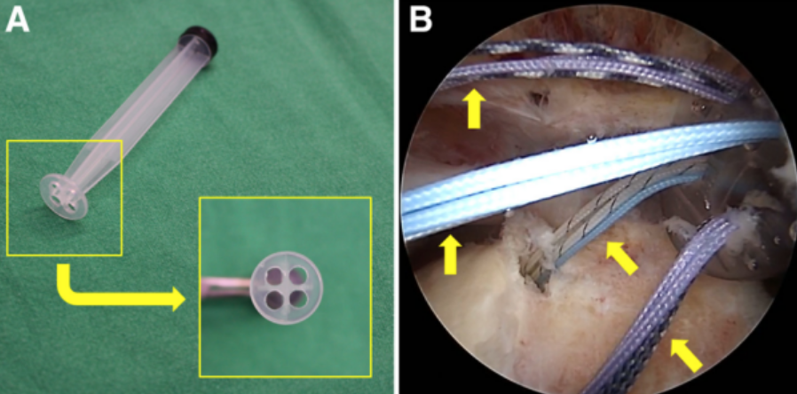 巨大不可修复性上关节囊重建新选择--脱细胞真皮基质同种异体移植物联合残余肌腱加强