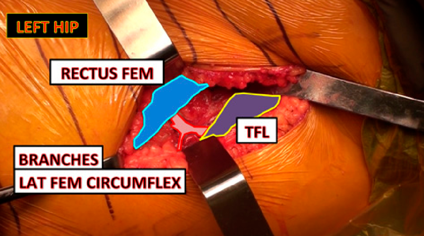 图解侧卧位DAA人工全髋关节置换术