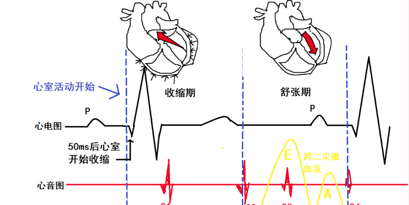 心电图如何报告死亡与濒死心电图​诊断