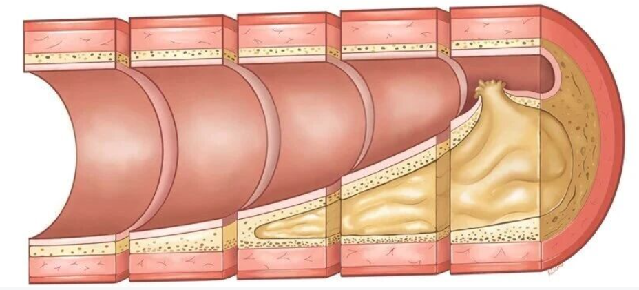 他汀消退冠脉斑块证据最广，心脏CT无创检查斑块最有前景！欧洲科学声明