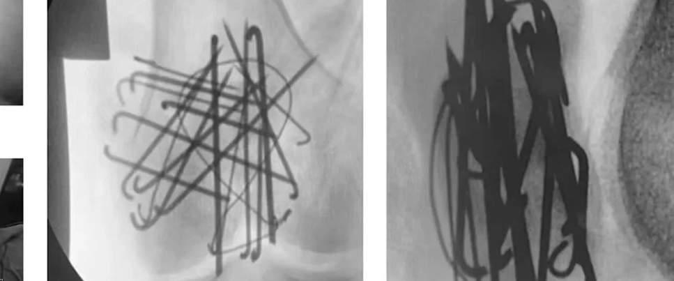 髌旁外侧入路联合“刺猬”技术治疗复杂粉碎性髌骨骨折