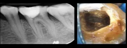 三种根充材料临床使用效果对比,你常用的是哪种?