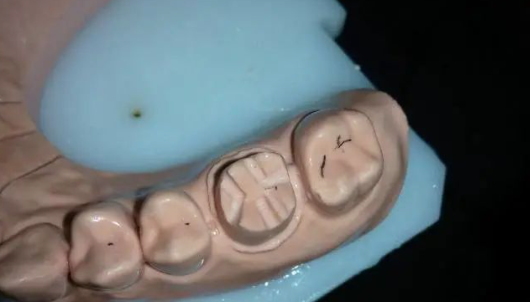 三根车针，六步完成——快速磨牙全冠预备