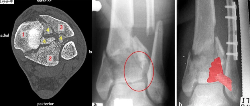 复杂Pilon骨折：诊疗原则与手术策略（12条要点）