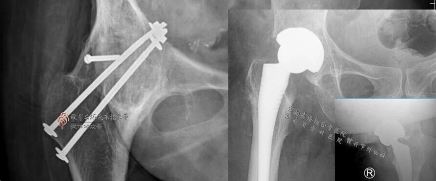 34张图文详解：21年融合髋THA的几点体会