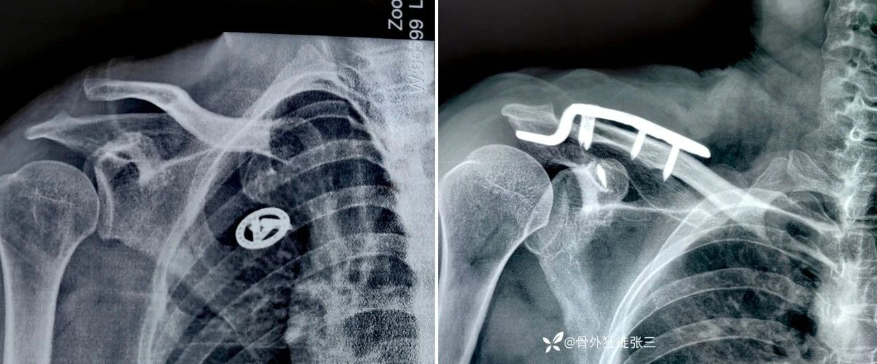 锁骨钩板真的过时了吗？怎么才能避免并发症？