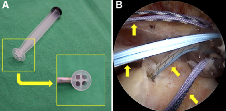 巨大不可修复性肩袖撕裂上关节囊重建新选择--脱细胞真皮基质同种异体移植物联合残余肌腱加强