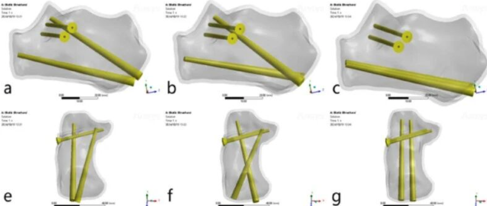 跟骨骨折：微创经皮螺钉固定的最佳螺钉分布及直径