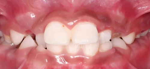 2X4矫治技术要点