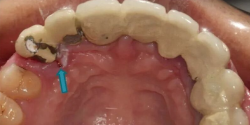 没拆冠,充完麻了,一例根管治疗引发的罕见病例