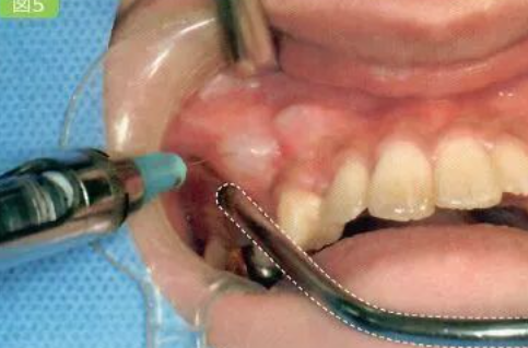 拔牙中吸唾器的使用技巧