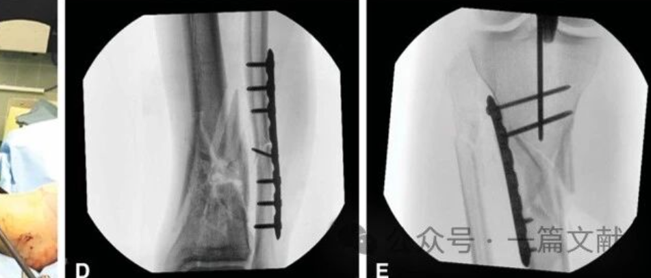 图解胫骨髓内钉技术（2025）