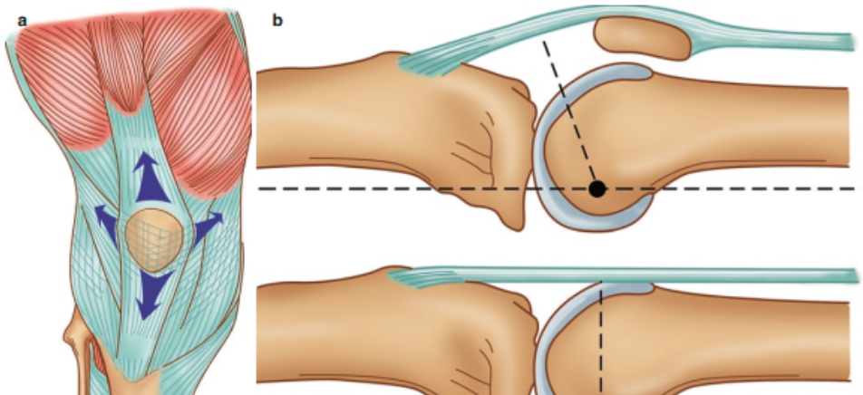 手术“金标准”：“克氏针张力带”内固定治疗髌骨骨折