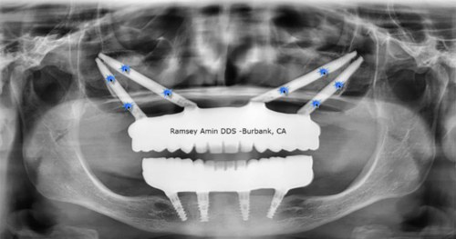 这样的种植方式,比穿颧穿翼更少见