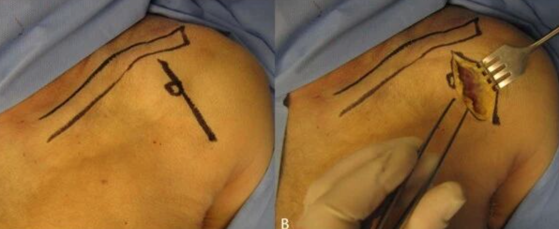 喙突骨折的ORIF：手术入路选择与固定技巧详解