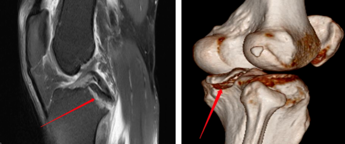 镜下双袢联合高强线“三重”固定后交叉胫骨止点撕脱骨折及分型