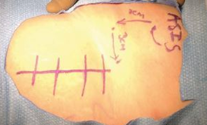 手术技巧：人工髋关节置换术，骨科医生须掌握！