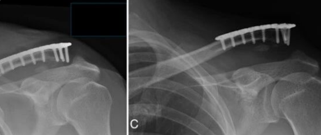 锁骨远端骨折内固定后为什么会翘起来？