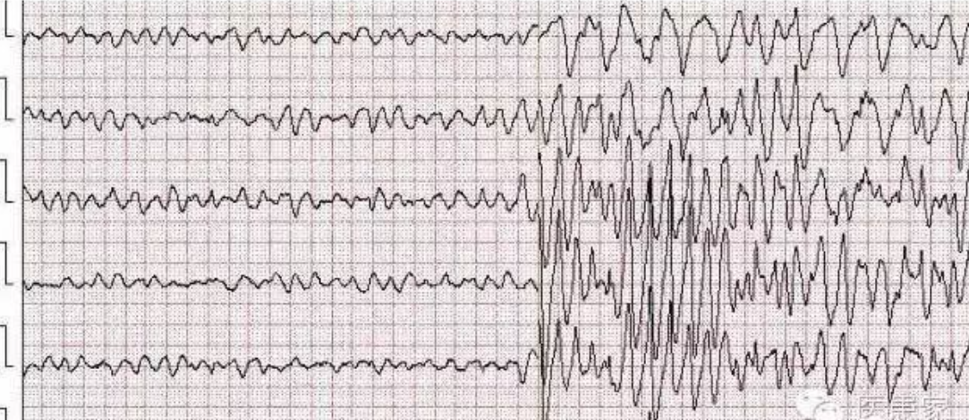 ​致命心电图，值班请牢记！