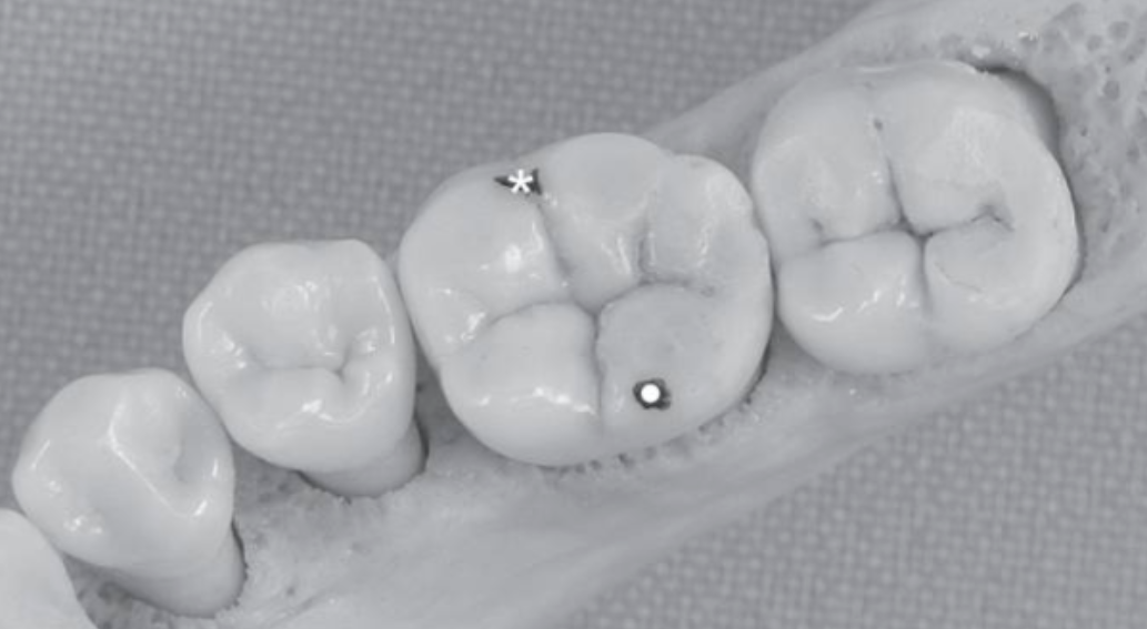 下牙槽神经麻醉的新方法！看起来挺厉害