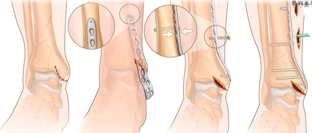 Pilon骨折手术入路环：7种手术入路解析