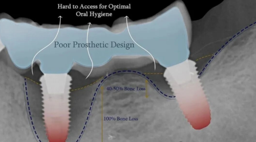 自然的骨增量,“奇怪”的现象