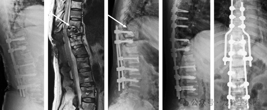 脊柱转移瘤患者术后症状性内固定失效