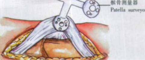 ​给你整理好了！人工膝关节置换手术步骤全解