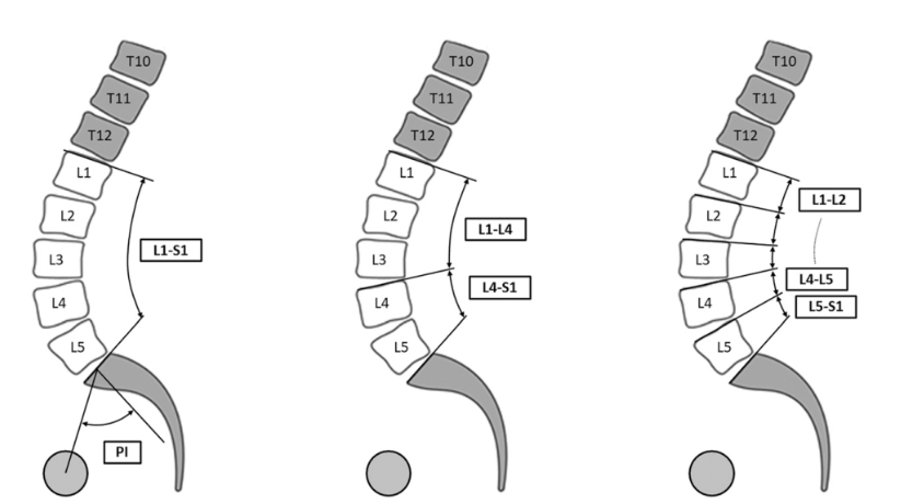 ​《JBJS》：腰椎退行性疾病中的矢状位平衡