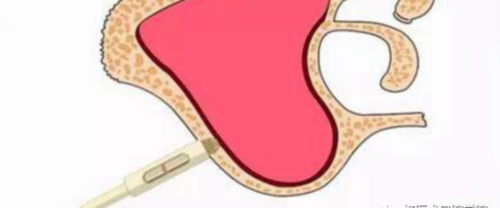 一文读懂与上颌窦提升术相关的上颌窦囊性病变!