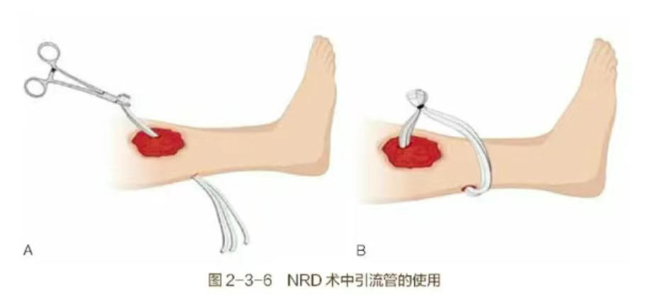 牛鼻子引流技术（nose ring drainage，NRD），适合基层医院推广