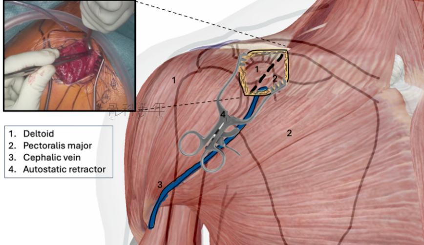  “8步骤”图解肩锁关节脱位改良入路Tightrope内固定