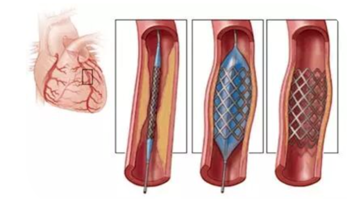 【干货】支架介入手术图文直播