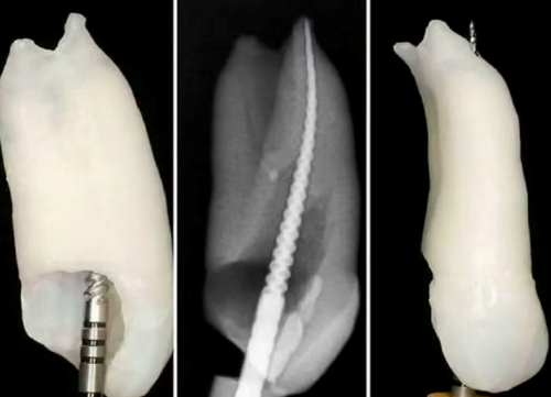 根测仪测完后,为什么要退0.5-1mm,图片解析很清楚