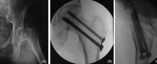 微创操纵杆技术(Joystick)在难复性股骨颈骨折复位中的应用