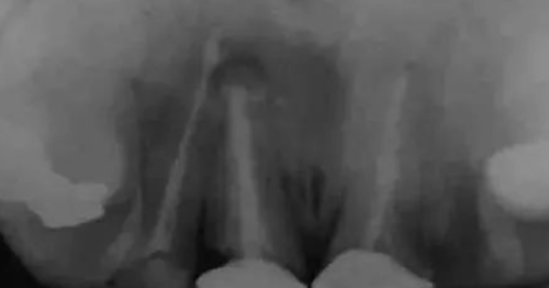 高清图文:根尖切除术操作全过程